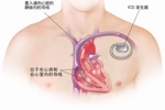战胜死神!埃里克森植入的ICD是什么?还能从事高强度的运动吗?